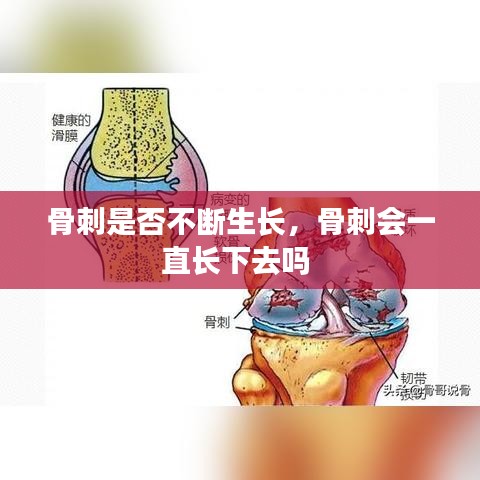 骨刺是否不断生长，骨刺会一直长下去吗 