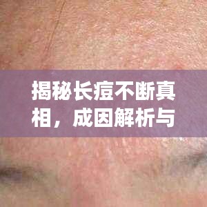 揭秘长痘不断真相，成因解析与应对良方